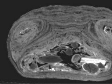 CT scan showing a mummified child's abdominal cavity.